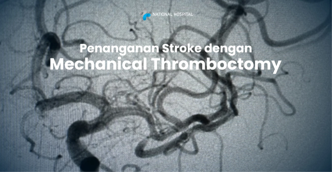 Penanganan Stroke Dengan Mechanical Thromboctomy