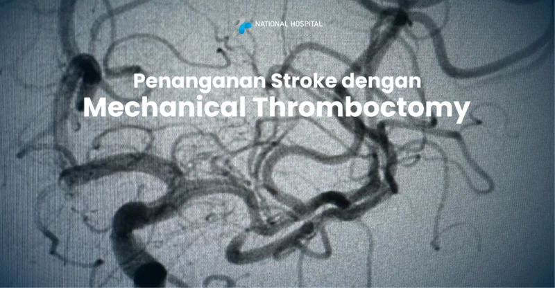 Treatment of Stroke with Mechanical Thrombectomy