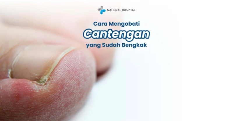 How to Treat a Swollen and Painful Ingrown Toenail