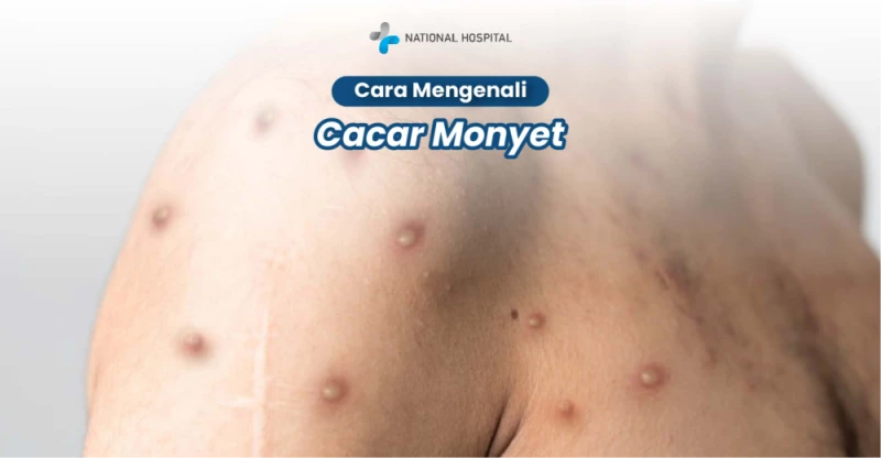 Monkeypox (Mpox): Recognizing Symptoms and Skin Lesions for Early Detection