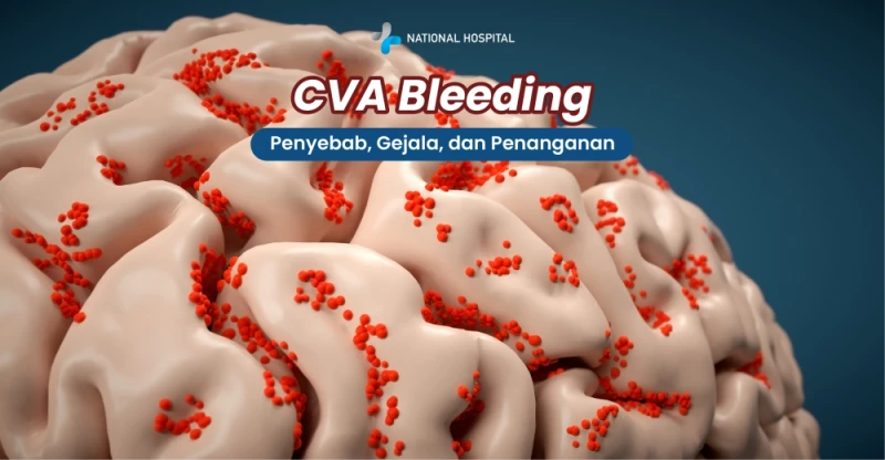 CVA Bleeding Is a Dangerous Type of Stroke: Here’s a Complete Explanation