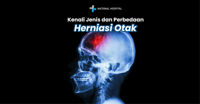 Recognize the Types of Brain Herniation and Their Differences