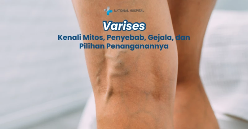 Varicose Veins: Understanding the Myths, Causes, Symptoms, and Treatment Options